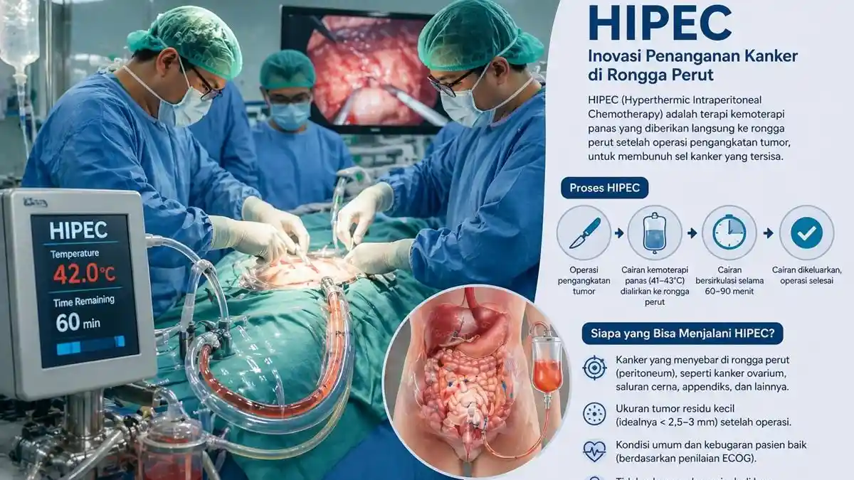 Terapi HIPEC, Inovasi Penanganan Kanker di Rongga Perut