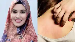 Kartika-Putri-dan-penyakit-Stevens-Johnson-Syndrome.jpg