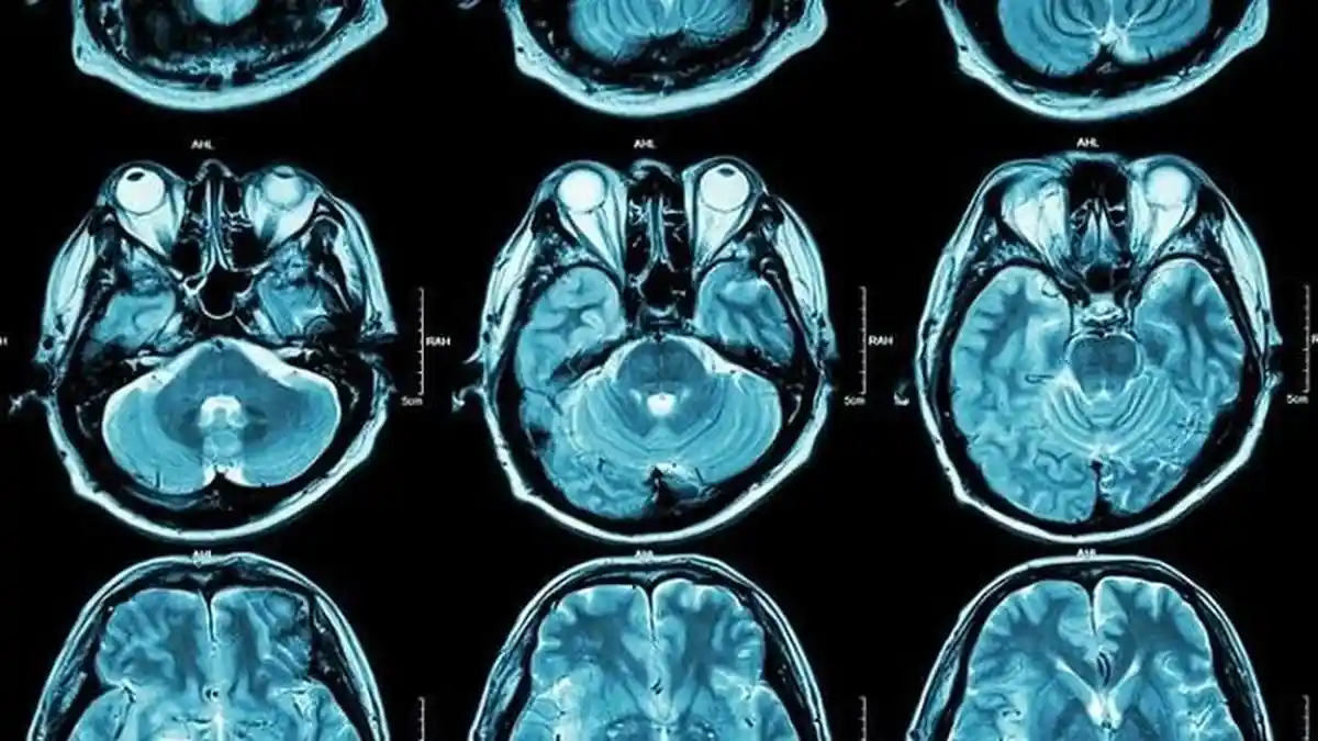 Penyakit Mematikan, Waspada 8 Gejala Awal Tumor Otak yang Perlu Diketahui