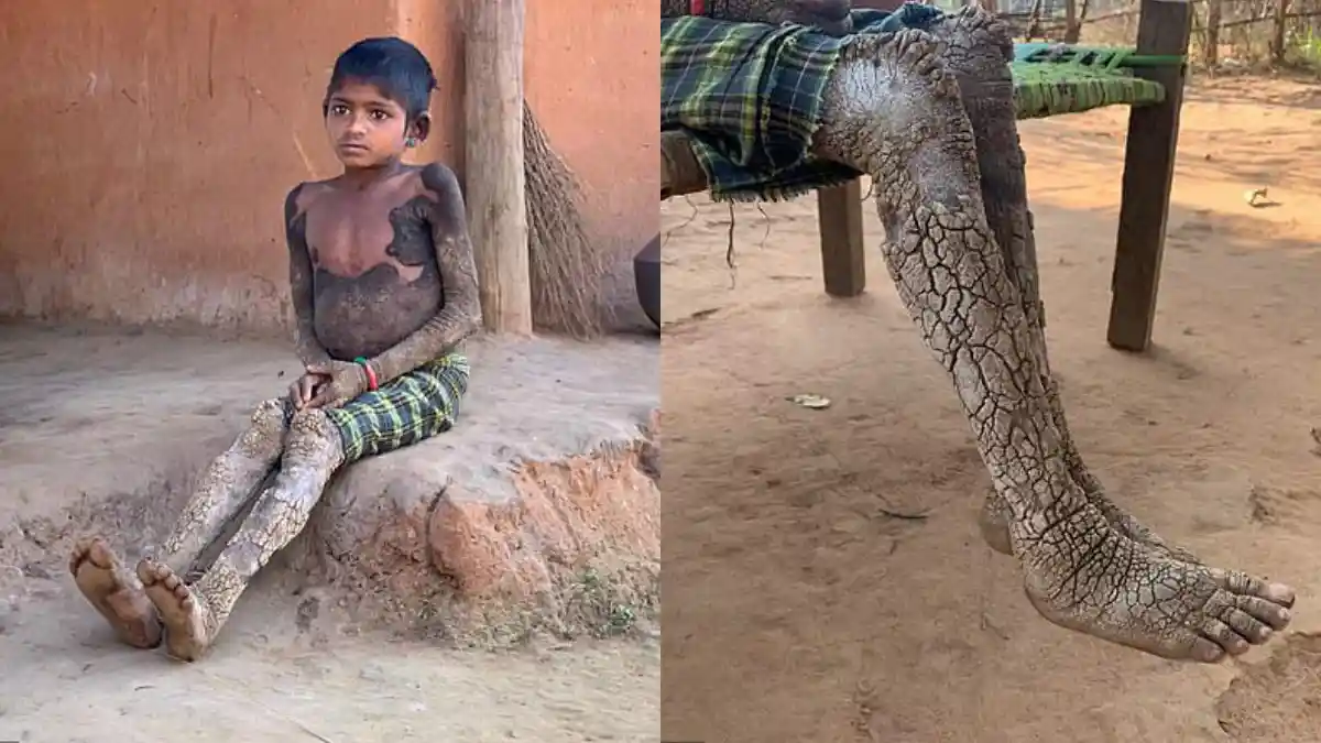 Idap Kondisi Langka, Tubuh Anak Perempuan ini Membatu Hingga Buat Hidupnya Terasa Seperti Neraka