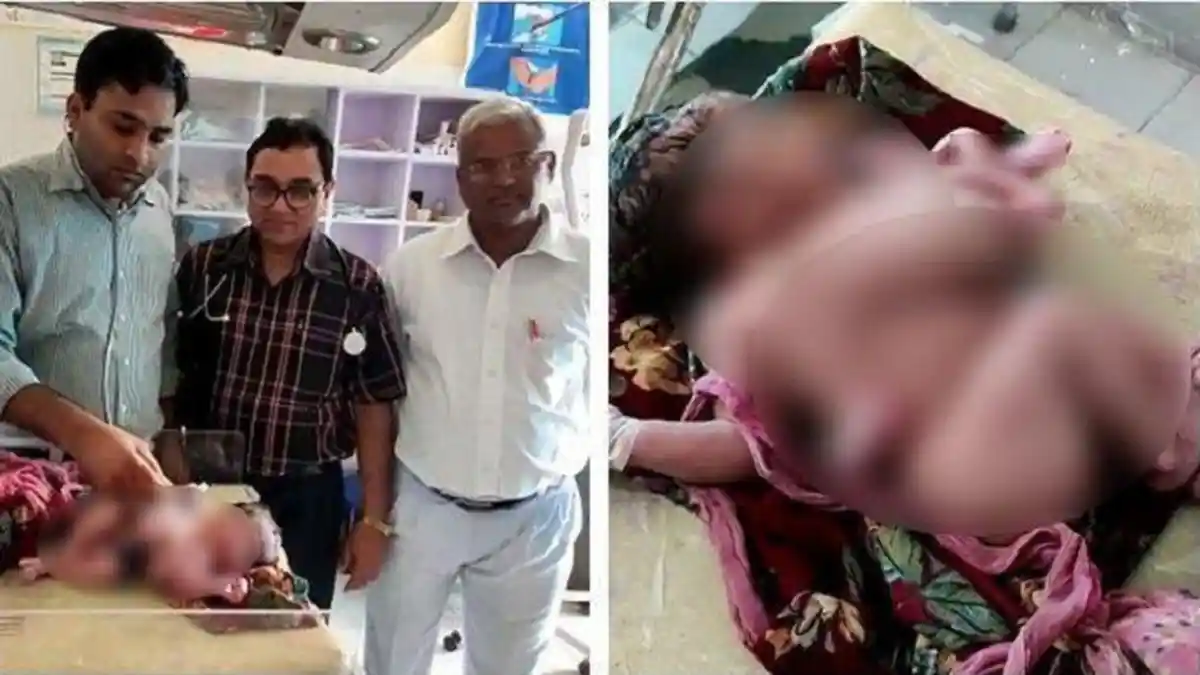 Aduh Tuhan e! Bayi Lahir dengan 4 Kaki dan 3 Tangan, Dokter Sebut Gara-Gara Hal Ini