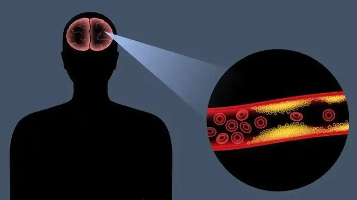 Kenali Gejala Awal Stroke Ringan dan Tips untuk Mengatasinya