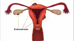 ilustrasi-rahim-ilustrasi-endometriosis.jpg