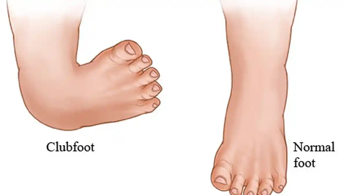 Bukan Cuma Genetik, Ini Faktor Risiko Kaki Pengkor pada Bayi Baru Lahir