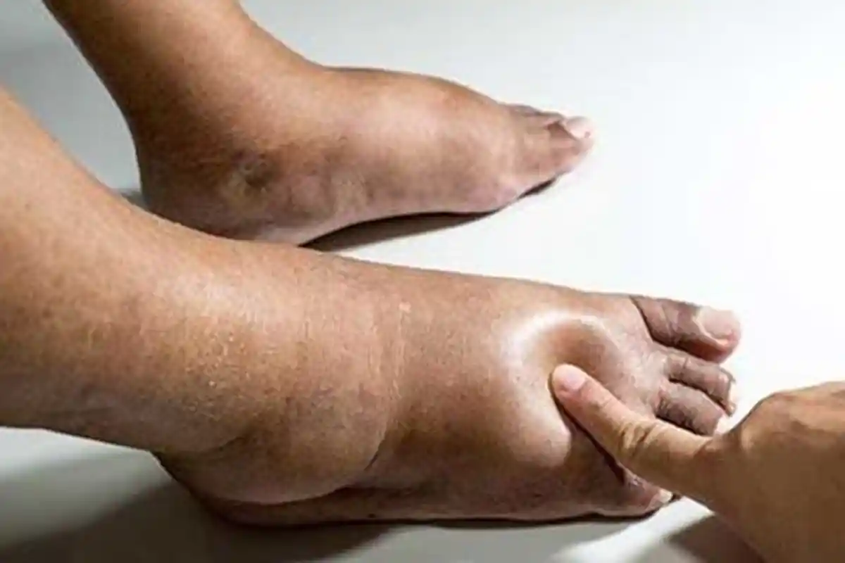 Gejala Penyakit Jantung Dilihat dari Kulit & Kuku: Kulit Berubah Warna Kaki Bengkak Kuku Melengkung