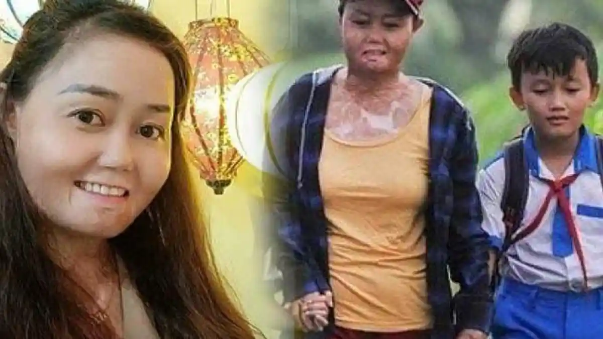 Suami Bakar Istri dan Anaknya karena Terlilit Utang, Sang Istri Alami Luka Bakar hingga 92 Persen