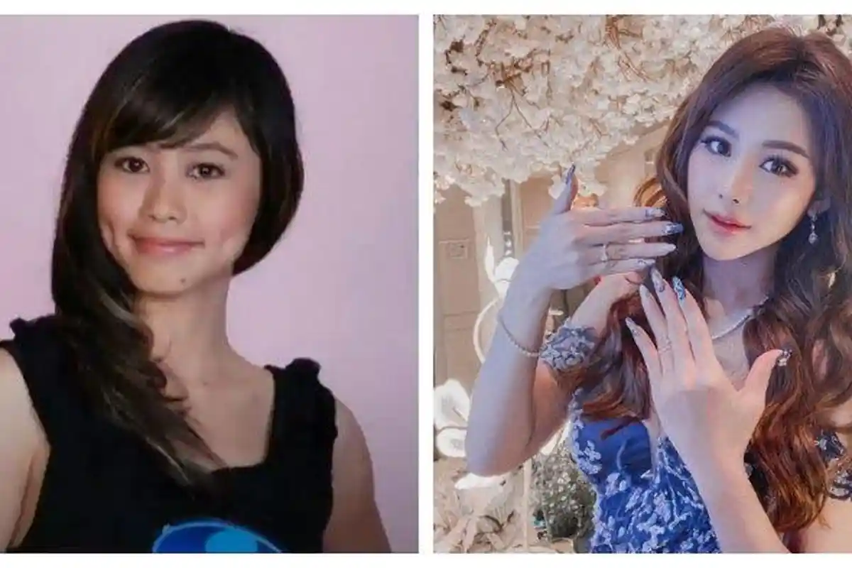 Panampilan Dyna Fransisca Berubah Drastis Pasca Operasi Plastik, Lihat Wajah dan Kulitnya