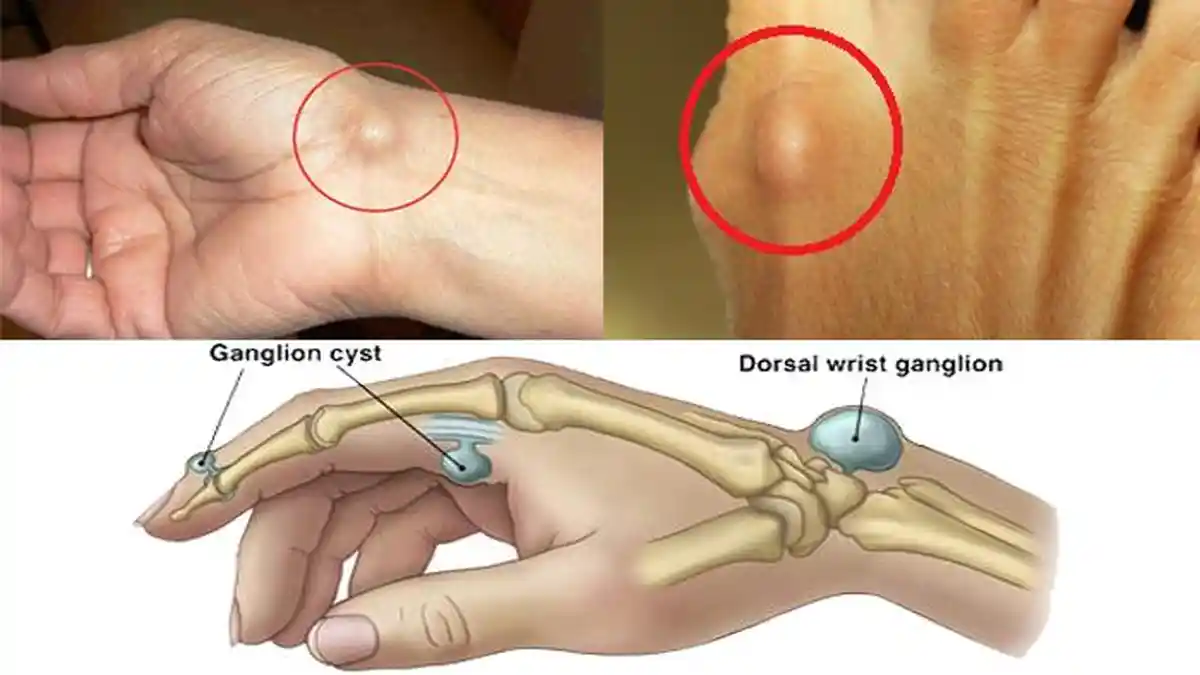 Benjolan Muncul di Tangan Atau Kaki, Bahayakah?