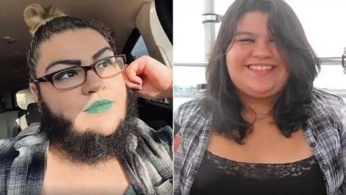 VIRAL Wanita Punya Brewok Lebat, Sempat Malu Hingga Rutin Cukur Setiap Hari, Kini PD Pamer di Medsos