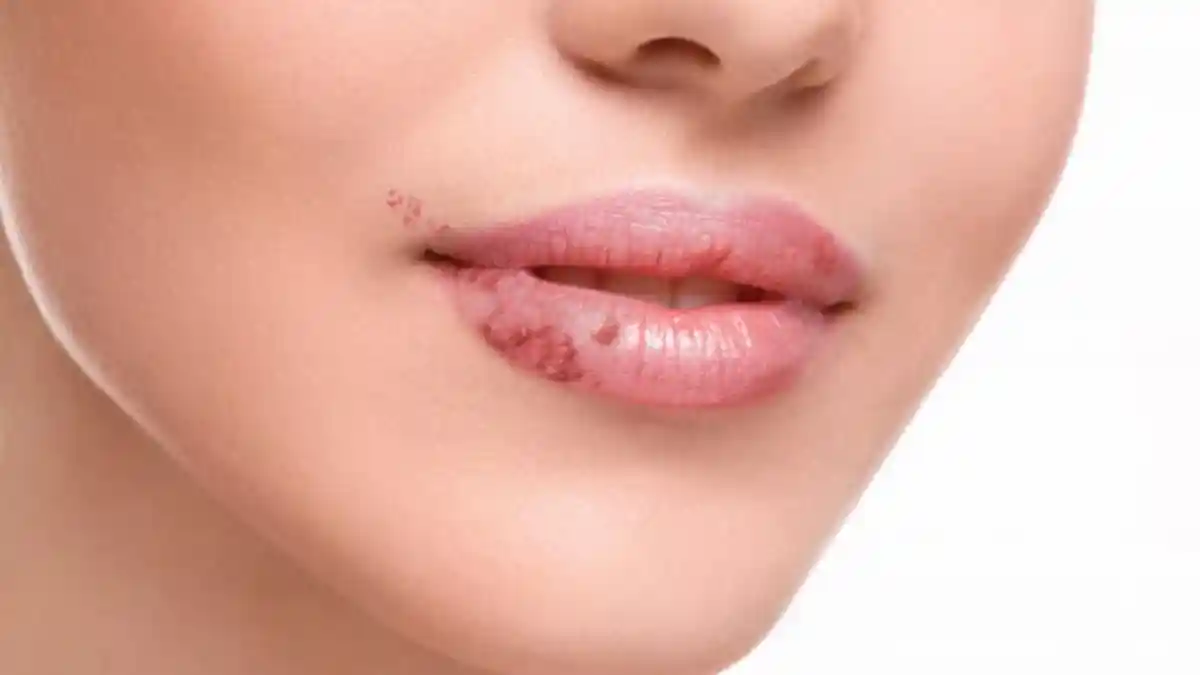 Timbul di Sekitar Mulut, Simak Penyebab dan Gejala Herpes Labialis, Bagaimana Mengatasinya?