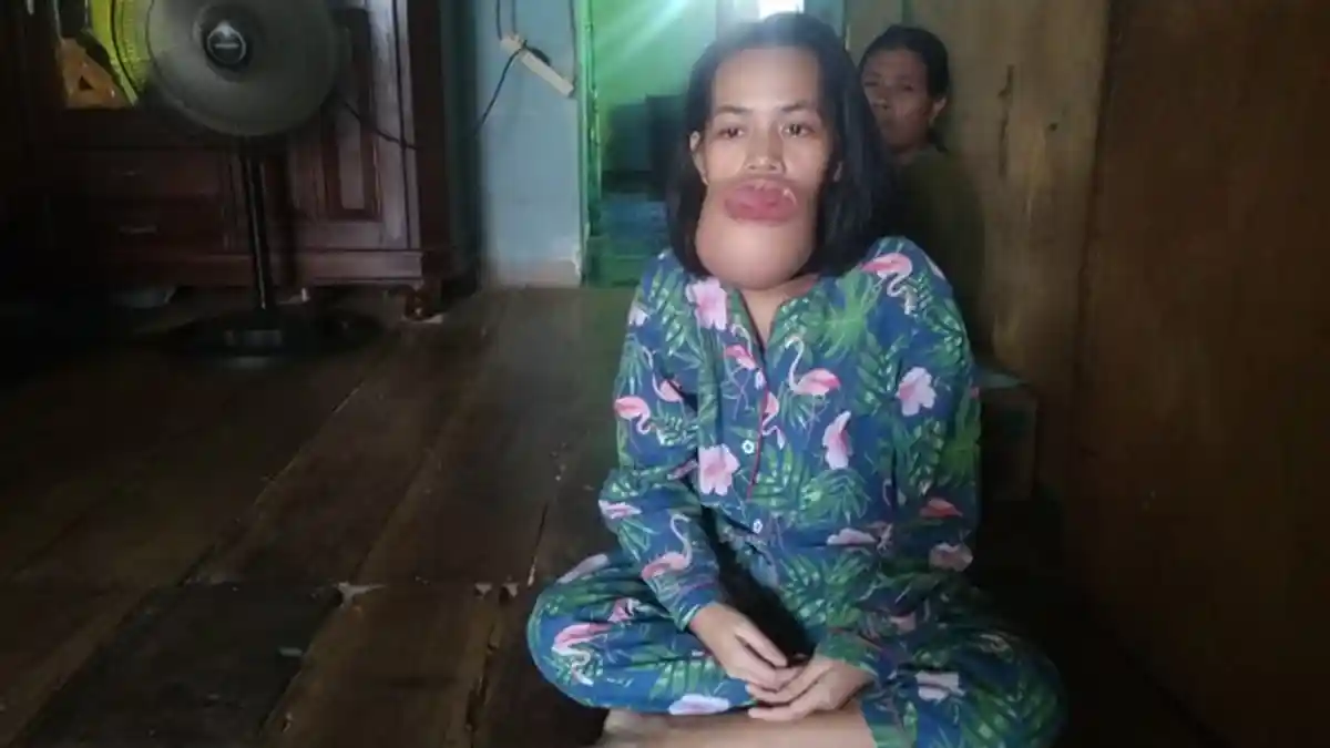 Gadis di Kertapati Butuh Bantuan, Benjolan Terus Membesar di Mulut, Diduga Idap Tumor Mandibula