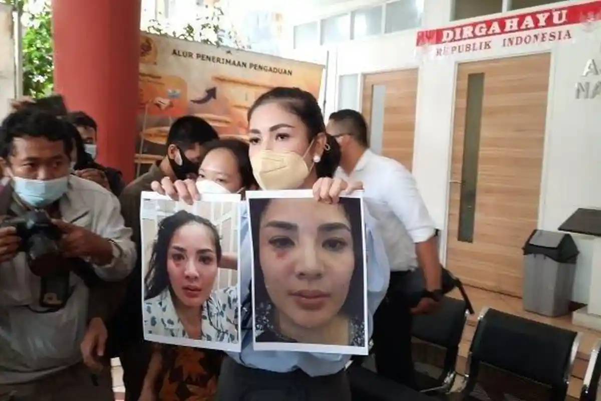 Nindy Ayunda Menderita Dalam Membangun Rumah Tangganya, Dipukuli Suami Hingga Bengkak