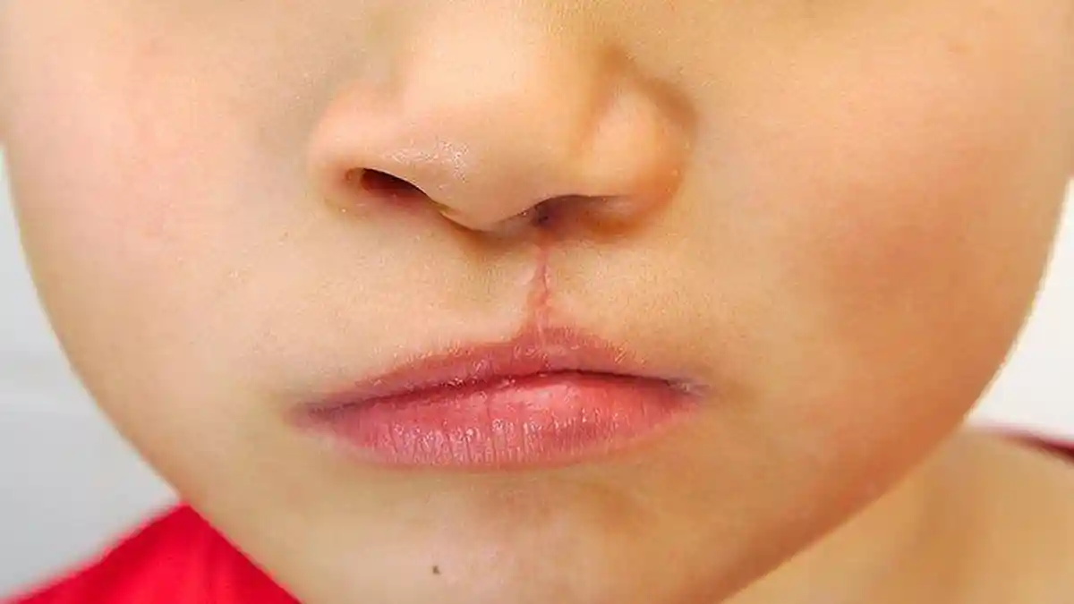 Kenali Penyebab Bibir Sumbing dan Cara Penanganannya