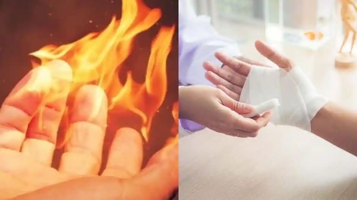 Warga Baranangsiang Bogor Luka Bakar 30 Persen, Pemkot Tanggung Biaya Pengobatan