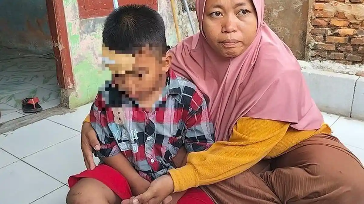 Bocah Depok Digigit Monyet Liar, Korban Alami Luka 10 Jahitan