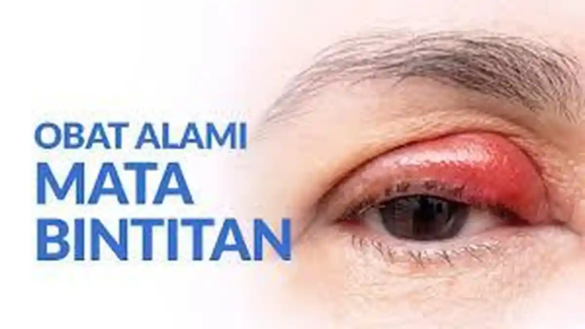 5 Cara Mudah dan Efektif Mengatasi Bintitan Secara Cepat, Tanpa Pergi ke Rumah Sakit