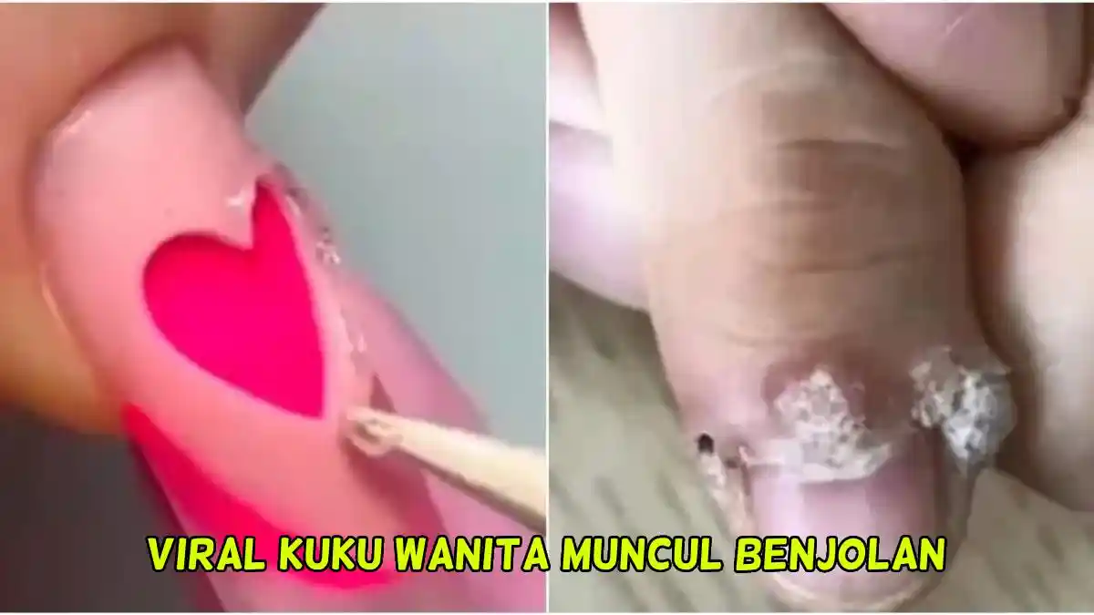Ngeri! Jari Wanita Ini Timbul Benjolan Mirip Bunga Kol Setelah Lakukan Manikur, Terinfeksi HPV