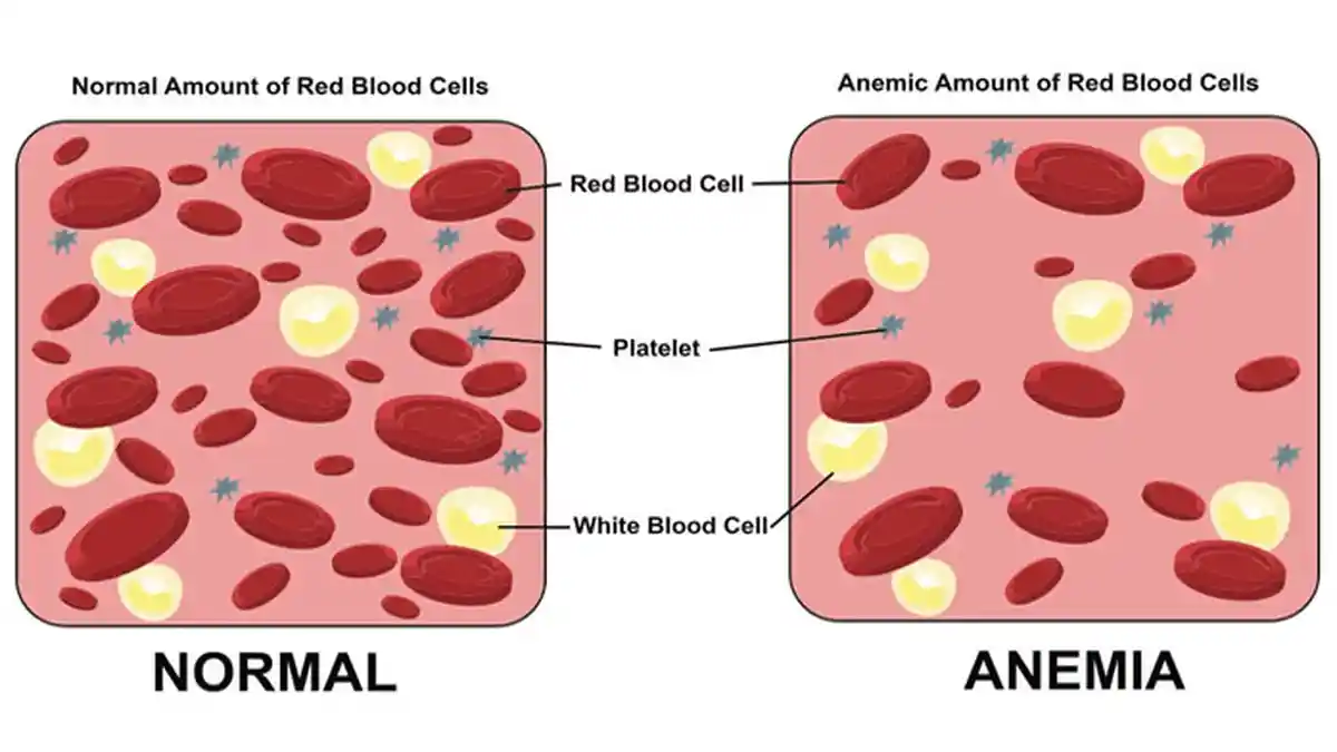 INFO SEHAT HARI INI - 6 Tanda Anemia yang Sering Diabaikan dan Cara Mengatasinya