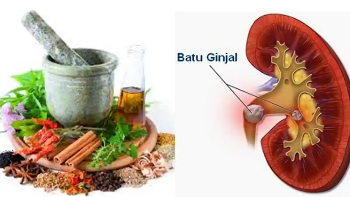Tak Perlu Operasi, Campuran Bahan Herbal Ini Ampuh Mengatasi Batu Ginjal, Begini Caranya