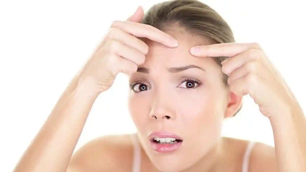 Dahi Berjerawat Karena Berponi? Simak Tips dan Trik Berikut Agar Cantik Bebas Jerawat