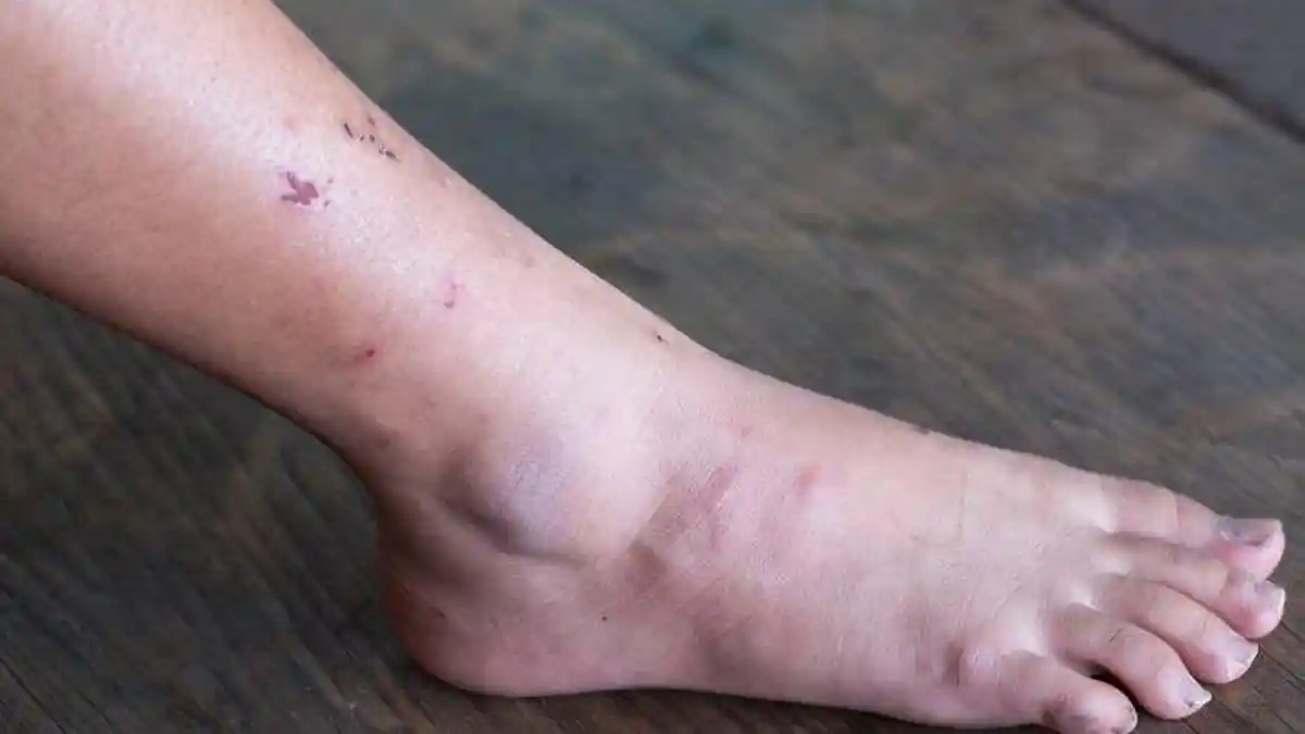 Sederet Cara Menghilangkan Bekas Luka di Kaki yang Sulit Hilang