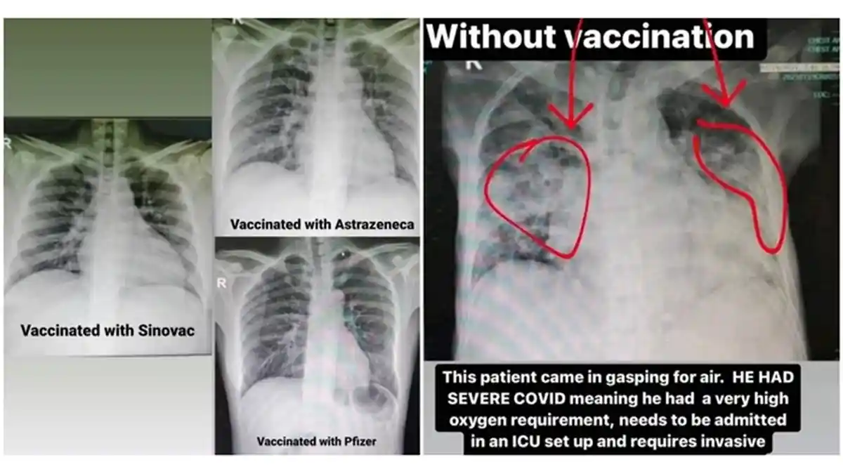Viral, Dokter ini Tunjukkan Hasil Rontgen Pasien Covid-19 yang Belum dan yang Sudah Divaksin