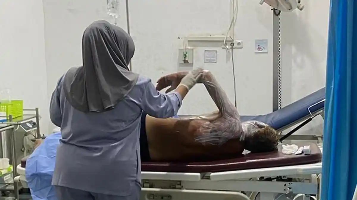 Pekerja Panglong di Sabang Alami Luka Bakar 54 Persen, Dirujuk ke RSUDZA