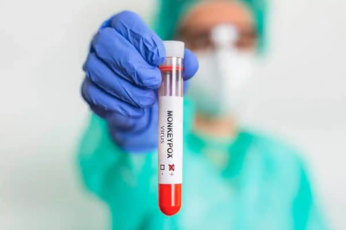 IDI Meminta Semua Dokter Mewaspadai Gejala Cacar Monyet pada Pasien