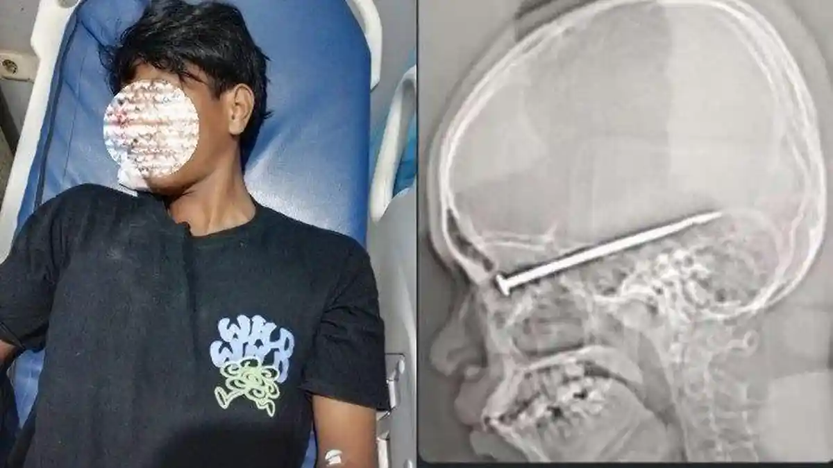 POTRET Mata Kanan Pemuda di Kendari Tertancap Anak Panah, Korban Pembusuran Saat Mau Antar Teman