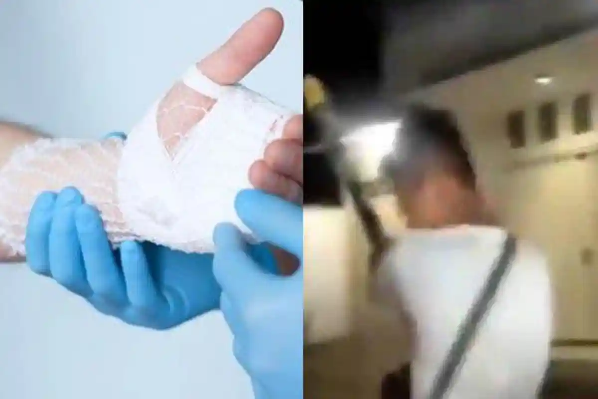 DUARR! Iseng Main Kemban Api Berujung Petaka, Pria di Merauke Dilarikan ke RS & Jarinya Diamputasi