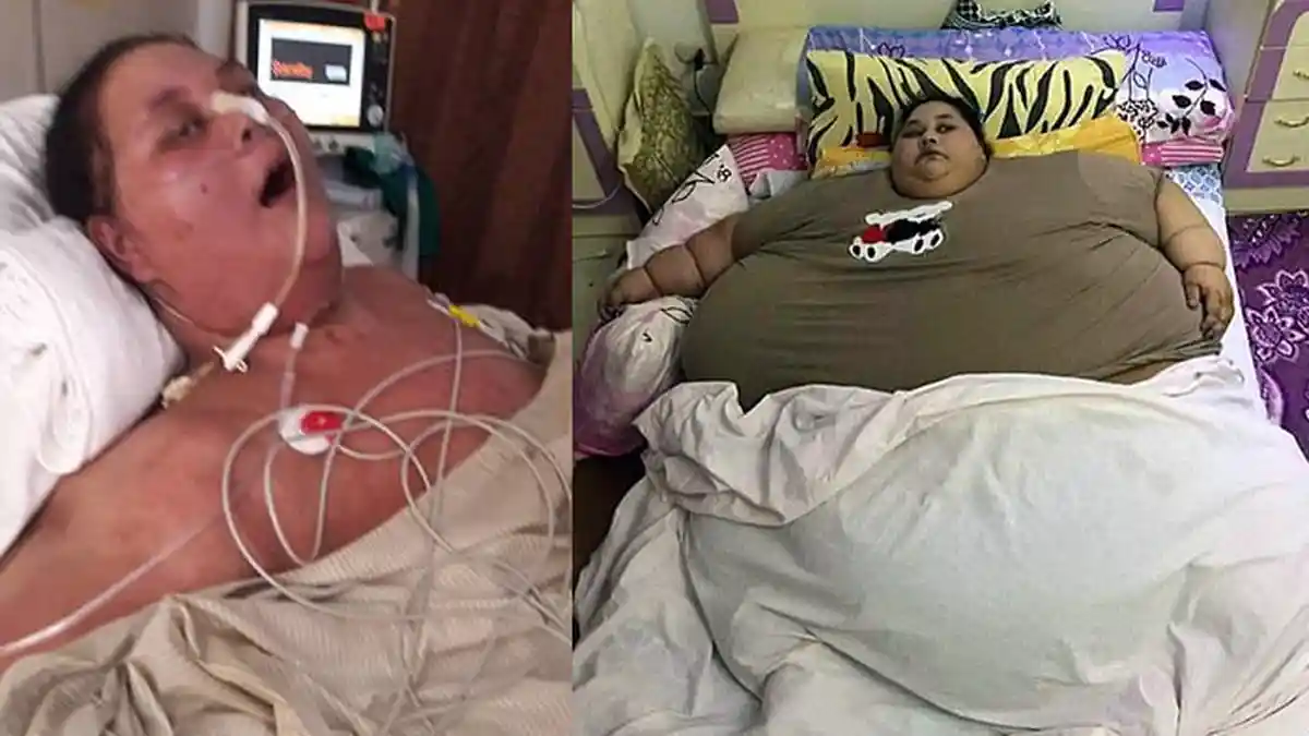 Paska Operasi, Eman Ahmed, Wanita Paling Gendut Sedunia Ini, Nasibnya Lebih Mengenaskan