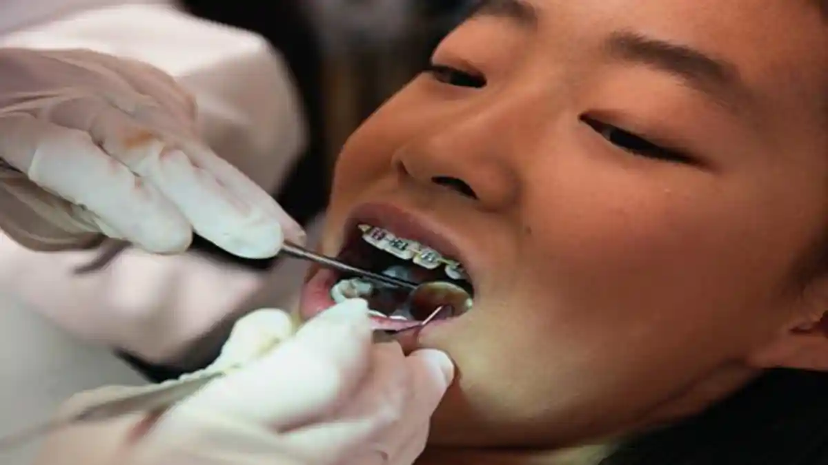 Bolehkah Menolak Rencana Pencabutan Gigi Bungsu Pasca Perawatan Ortho?
