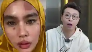 Kartika-Putri-mengalami-masalah-kulit-hingga-harus-berobat-ke-Singapura.jpg
