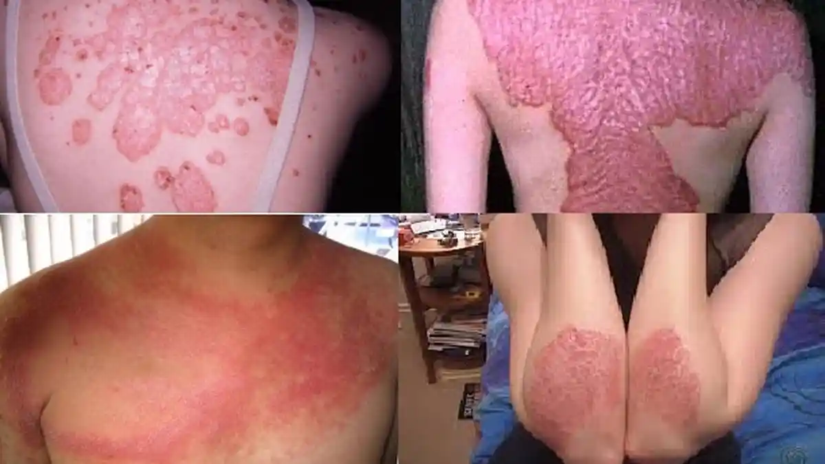 Cara Alami Terhindar Penyakit Kulit Psoriasis