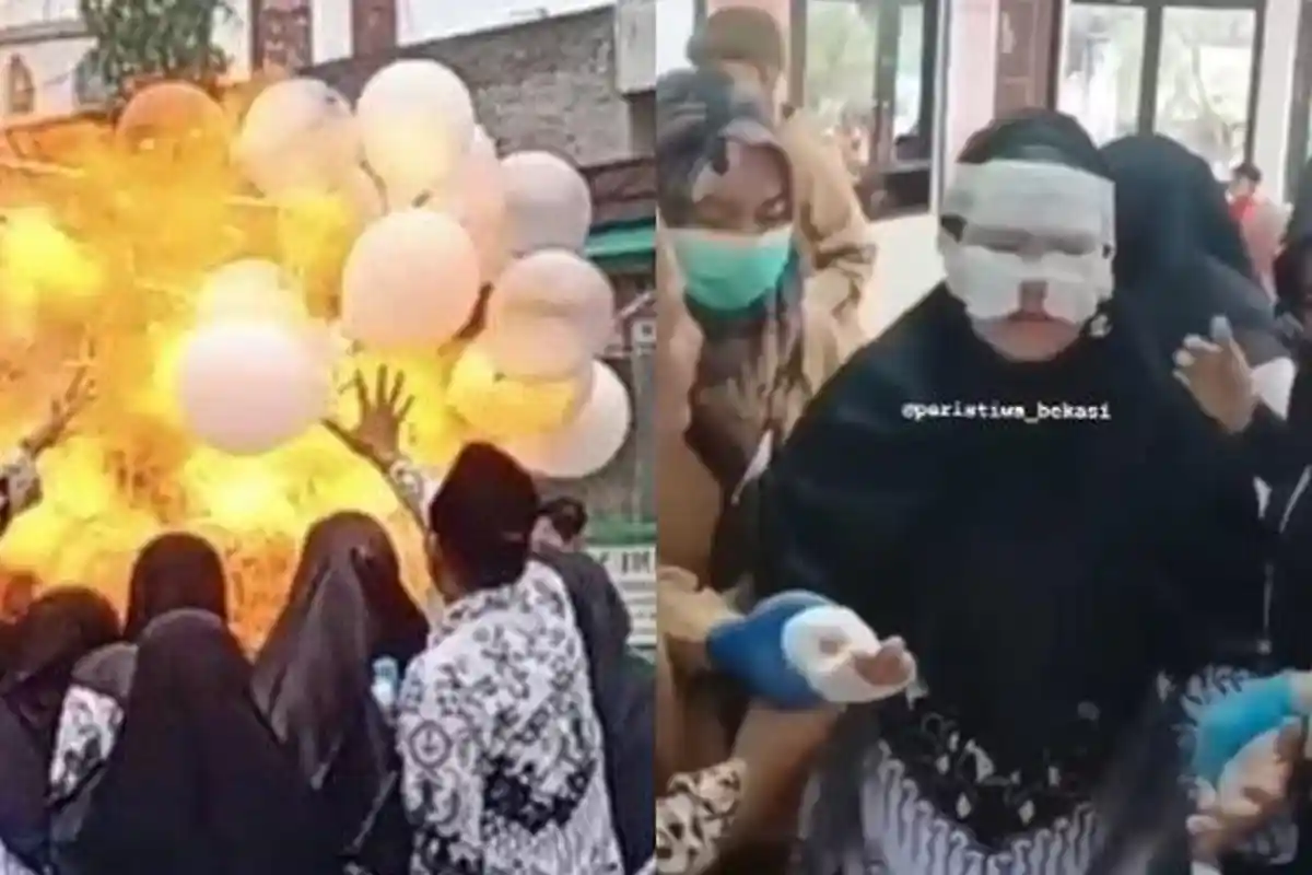 Kondisi Memilukan Guru SD Cimuning yang jadi Korban Balon Gas Meledak, Wajah Alami Luka Bakar Berat