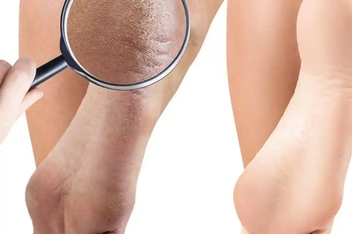 Tumit Kaki Anda Pecah-pecah ? Atasi dengan 4 Langkah Sederhana Ini