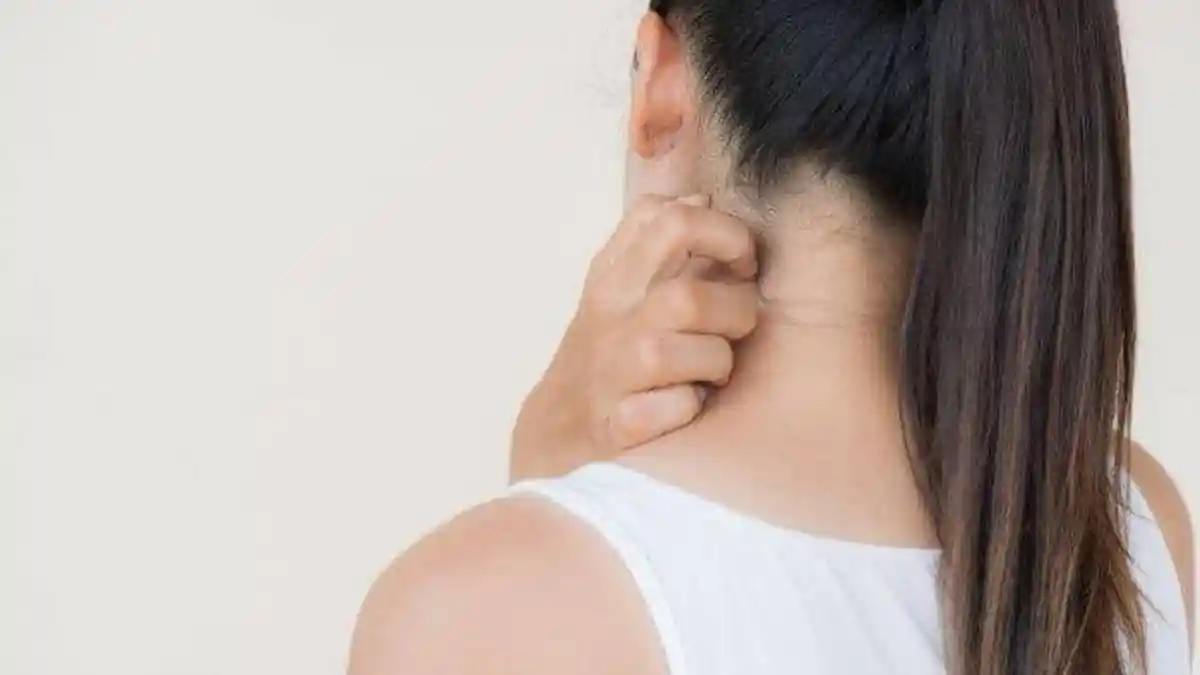 Pernah Kena Cacar Air? Anda Sangat Berisiko Terpapar Herpes Zoster, Apa itu? Ini Gejalannya