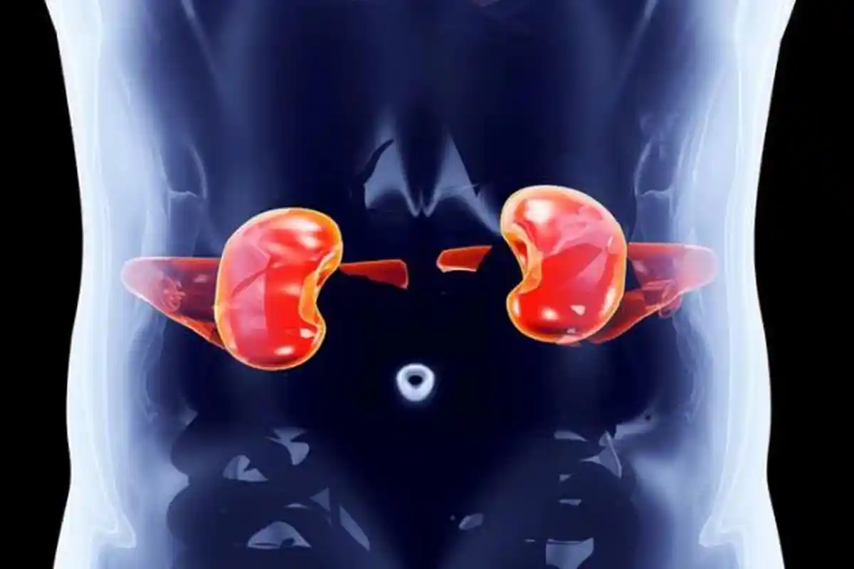 Sering Dikonsumsi, Berikut 6 Makanan Penyebab Batu Ginjal