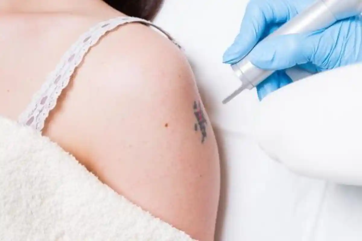 Anda Ingin Menghilangkan Tato di Tubuh, Begini Caranya