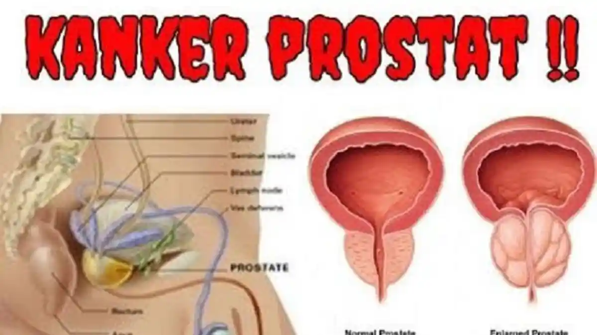 Lagi Heboh Kanker Prostat, Ini 13 Obat Alami untuk Masalah Prostat Pada Pria