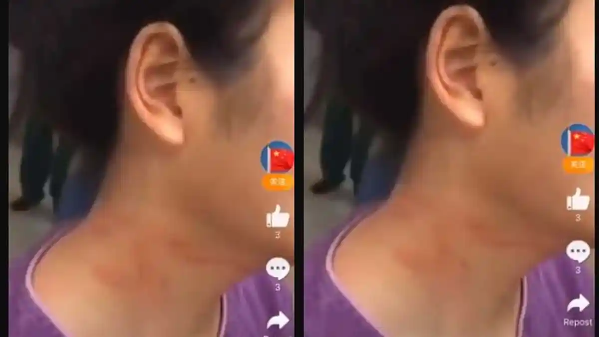 Tragedi Pasien Corona Hendak Kabur dari Isolasi, Gigit-Cakar Perawat hingga Cedera, Polisi Bertindak