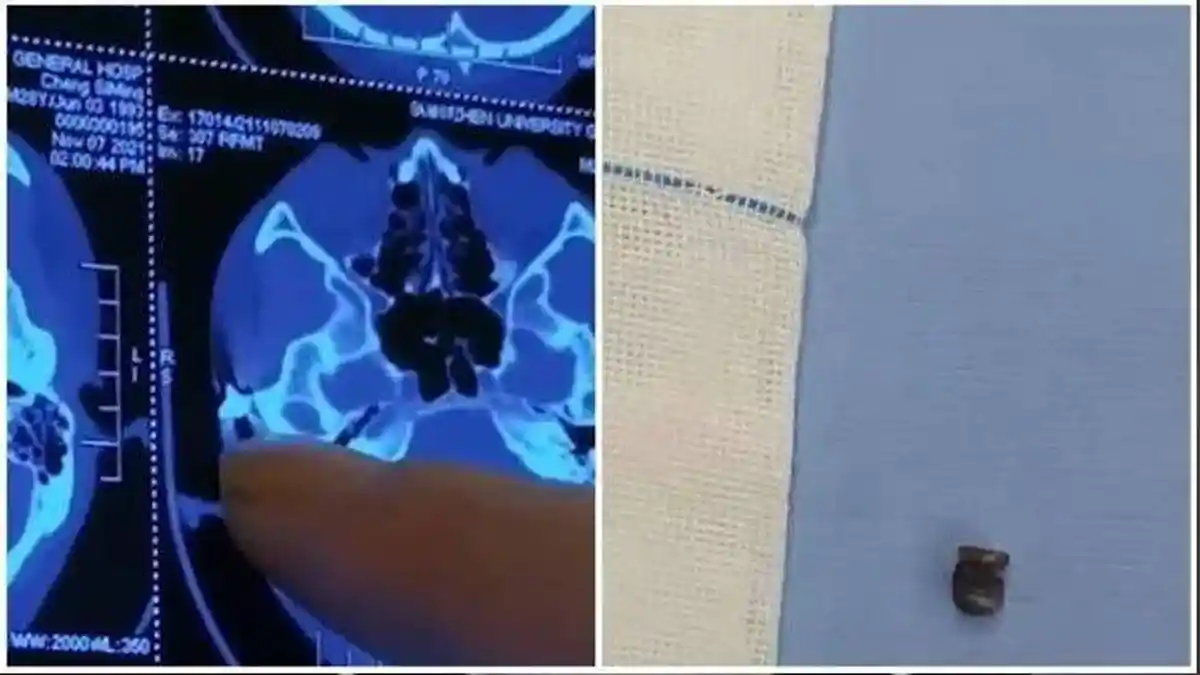 Awalnya Pria Ini Menganggap Sakit Kepala Biasa, setelah Dicek Hasilnya Mengerikan