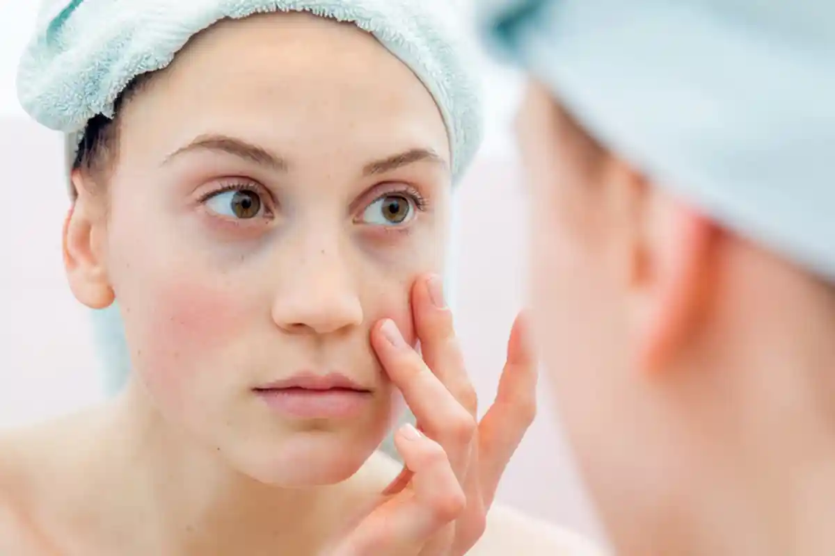 Kenali Gejala dan Berbagai Jenis Lupus, Penyakit 1.000 Wajah yang Sulit Dideteksi