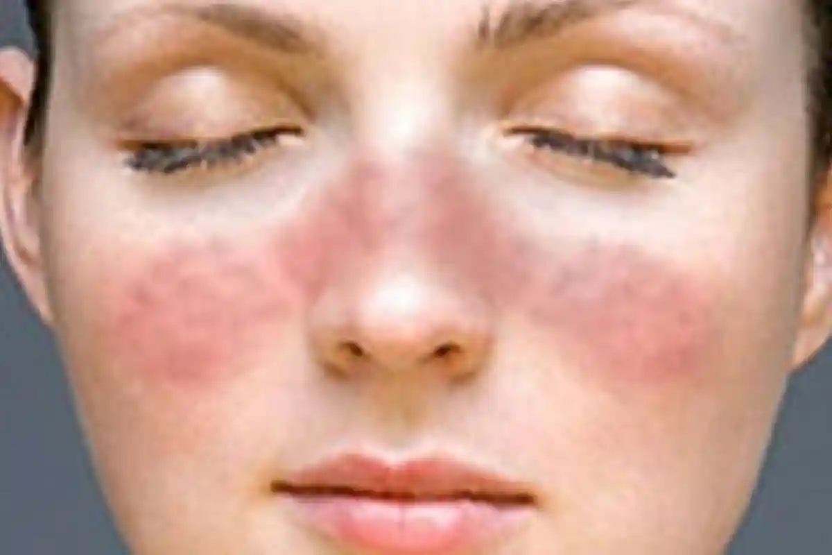 Daftar 11 Pertanyaan untuk Mengecek Anak Menderita Lupus