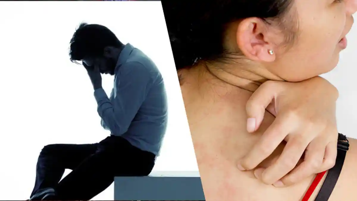 Jangan Sampai Terlambat, Kenali Penyebab dan Bagaimana Pengobatan Herpes Kulit, Ini Caranya