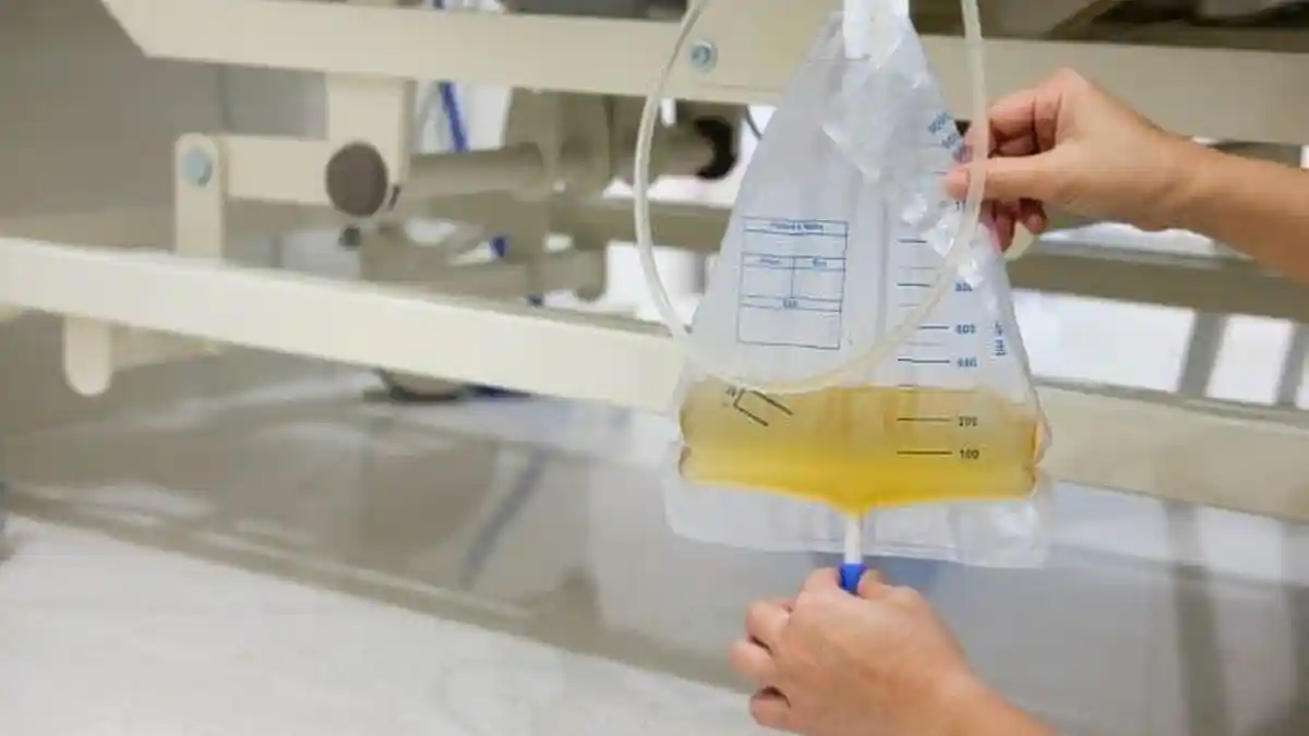 Mengenal Kateter Urine: Ini Kegunaan, Jenis, dan Prosedur Pemasangan Kateter Urine