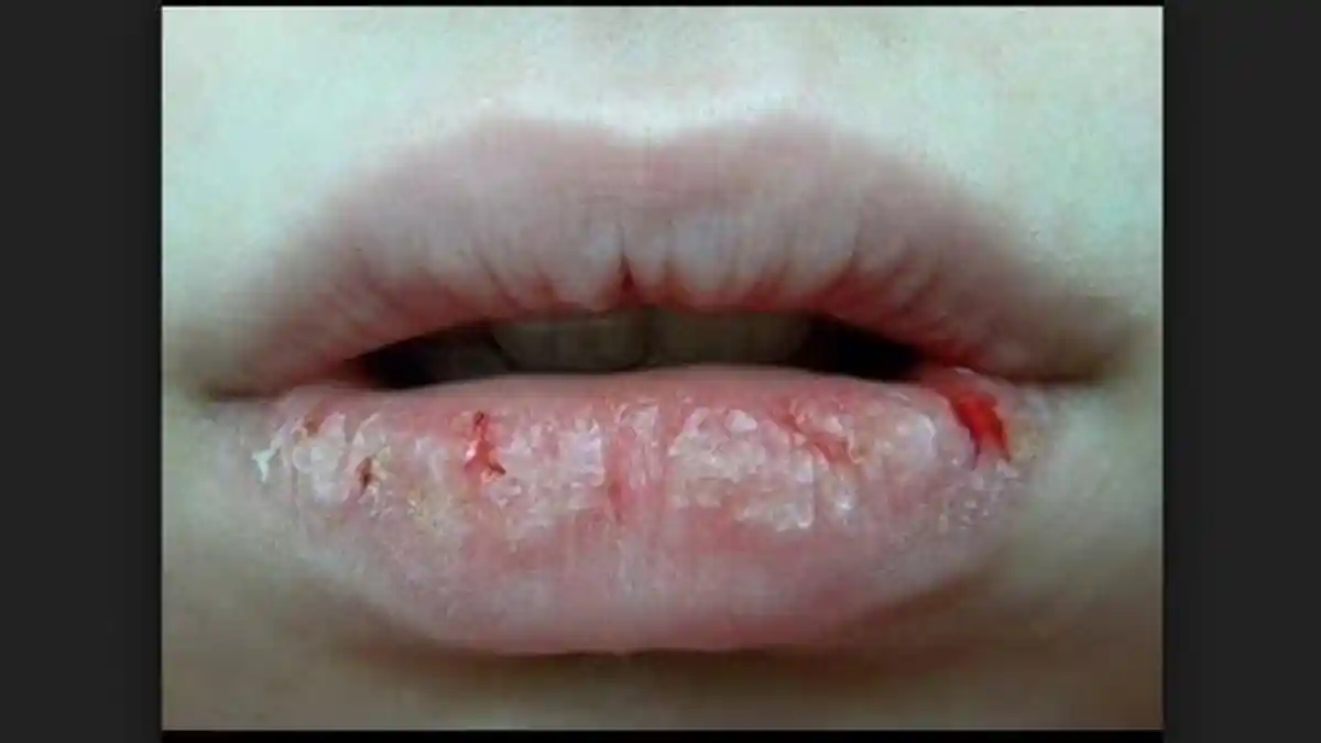 Pakai Pelembap Bibir karena Bibir Kering & Pecah-pecah di bulan Ramadhan, Bagaimana Hukum Puasanya?