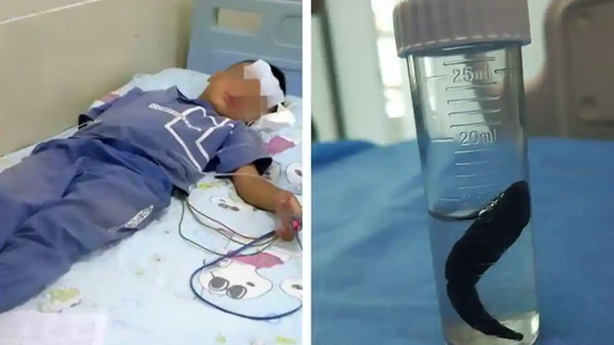 Bocah Ini Alami Batuk Berdarah 10 Hari, Setelah Dicek Ada Lintah Sepanjang 7 Cm di Tenggorokannya