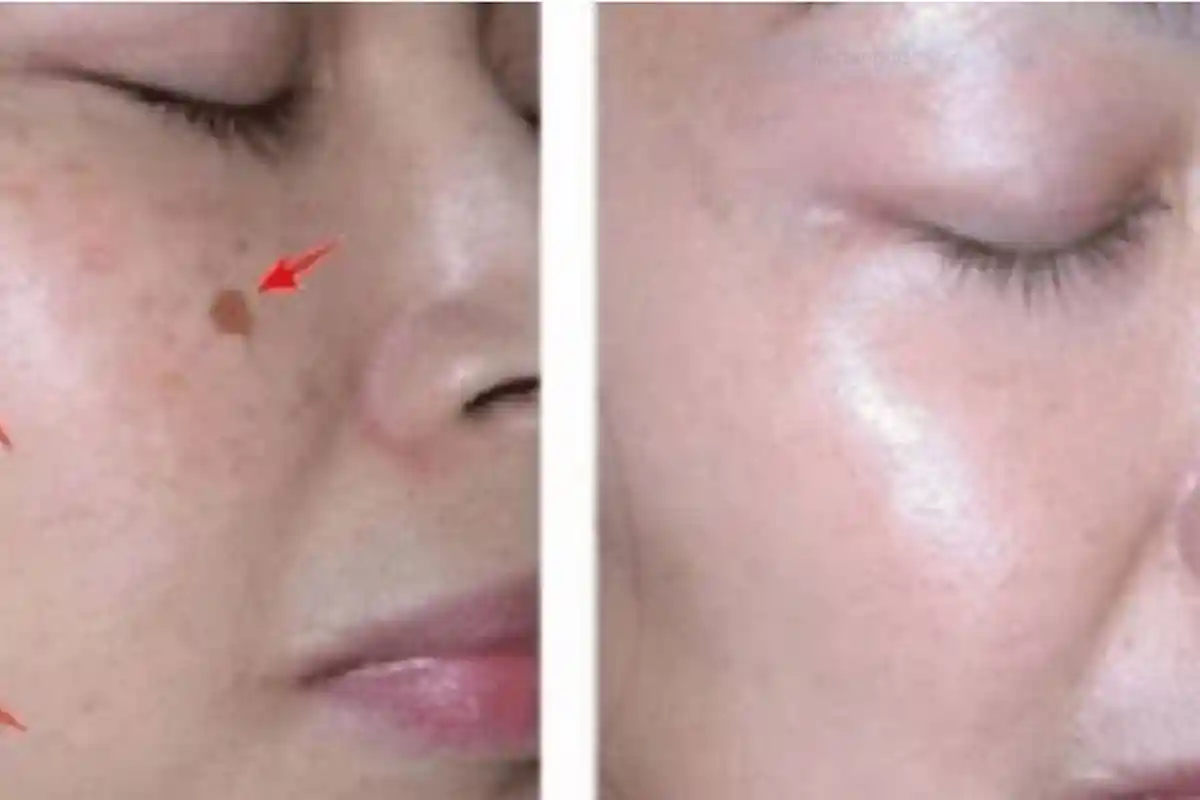 Cukup 3 Malam Saja Untuk Hilangkan Flek Hitam di Muka, Bahannya Adalah Berikut. . .