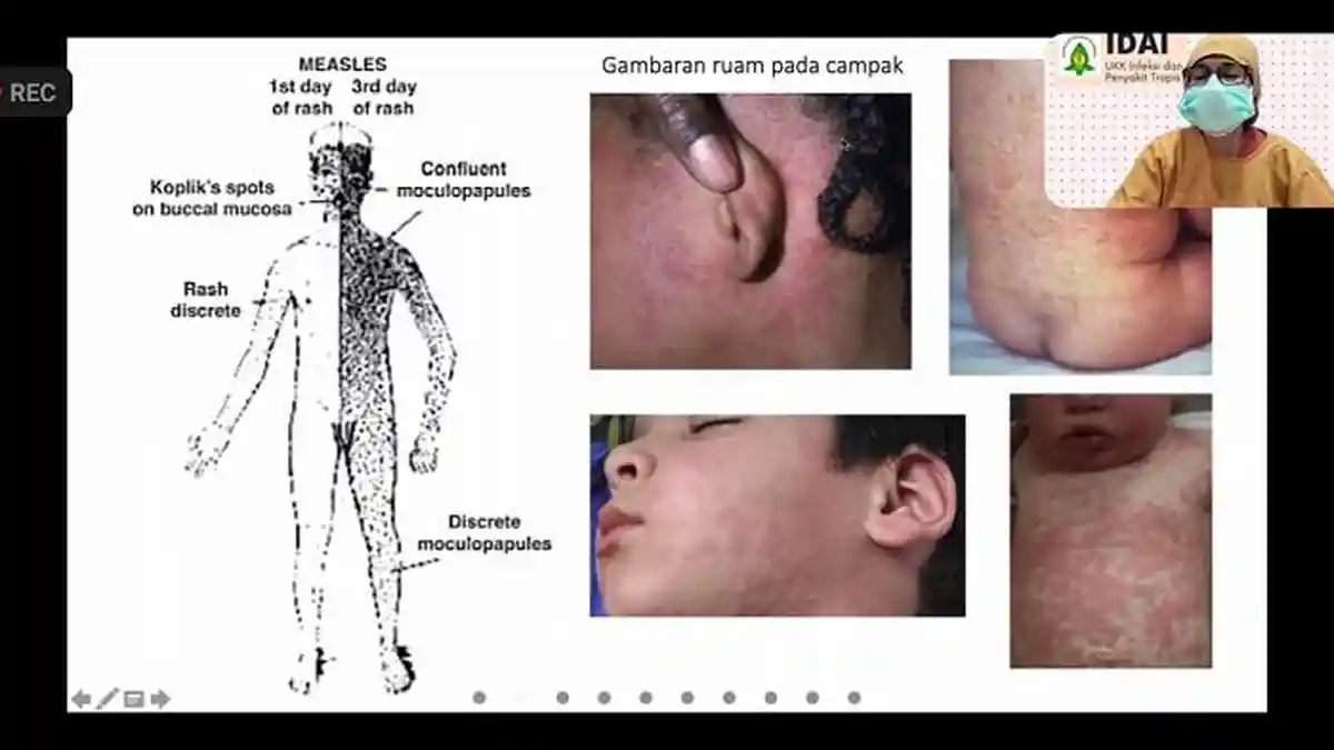 Jangan Anggap Sepele, Ini Bahaya Komplikasi dari Penyakit Campak